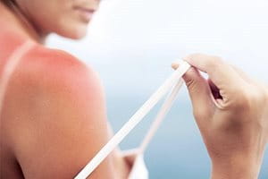 Njega površinskih opeklina