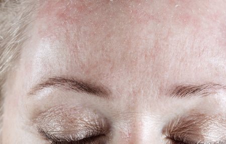 Ljuskavo čelo žene